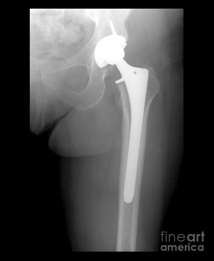 Hip Replacement Photograph by Medical Body Scans