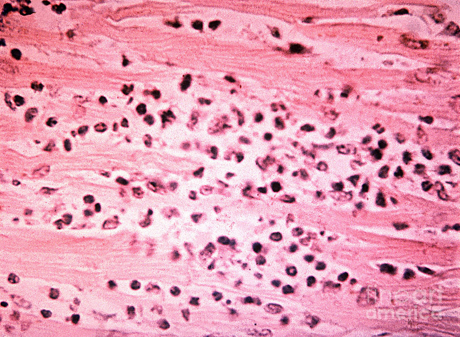 Bacteria Photograph - Histopathology Of Typhoid Fever by Science Source