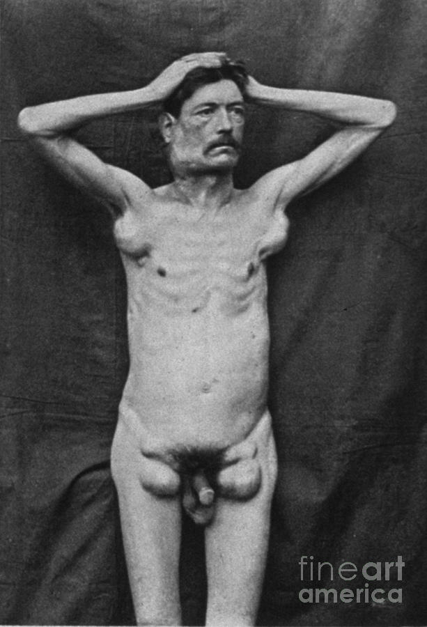 Hodgkins Disease, 1892 Photograph by Science Source
