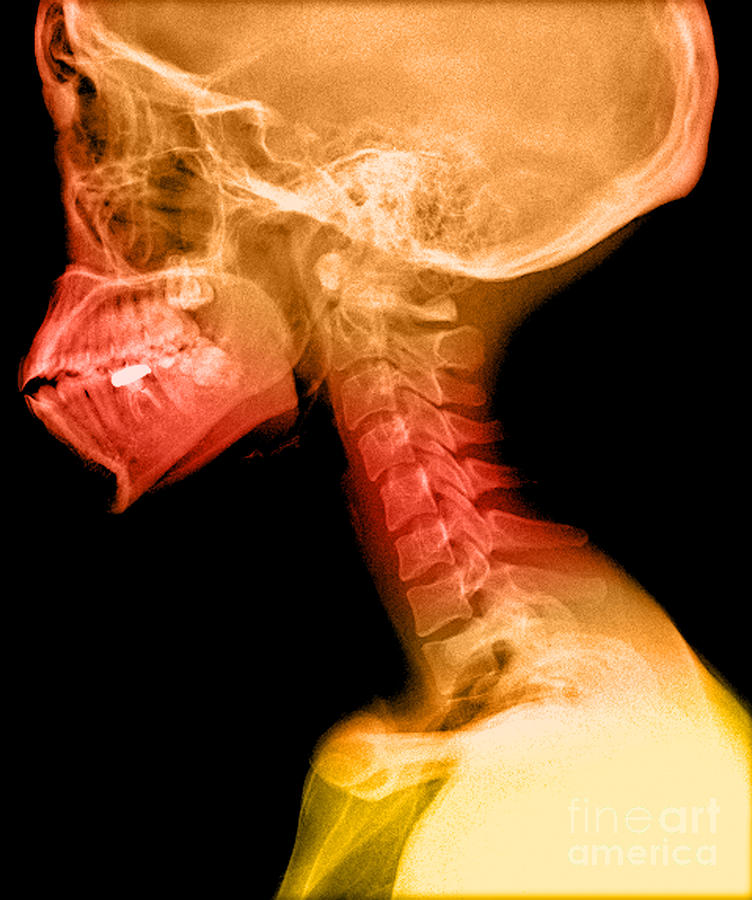 Human Skull And Cervical Spine Photograph by Medical Body Scans