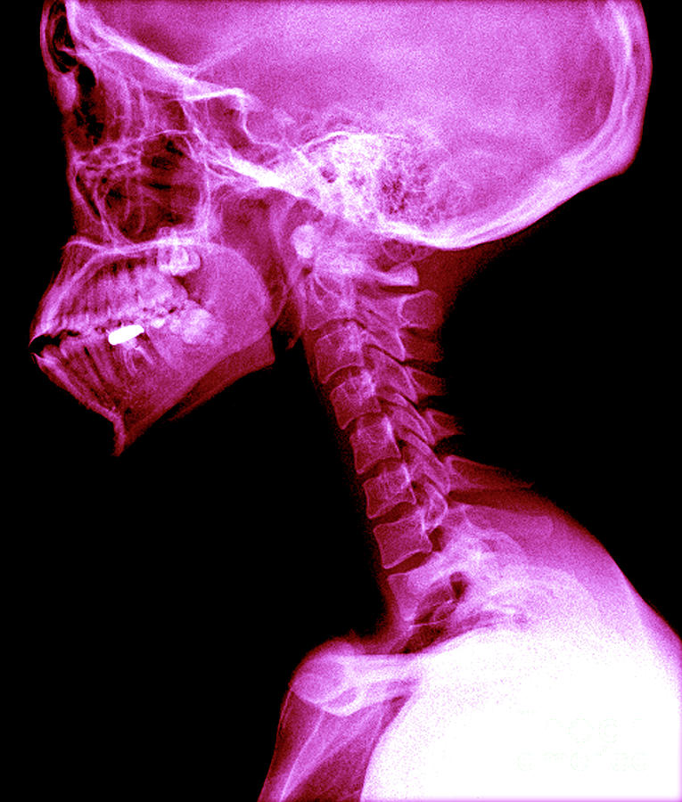 Human Skull And Spine Photograph by Medical Body Scans