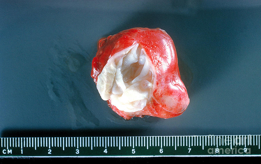Hydatid Cyst From A Human Lung Photograph by Science Source