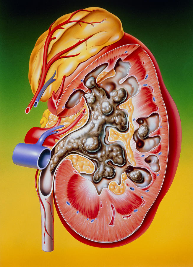 Illustration Of A Calculus Or Stone In The Kidney Photograph by Science ...