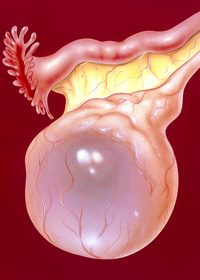 Illustration Of An Ovarian (follicular) Cyst Photograph by John Bavosi