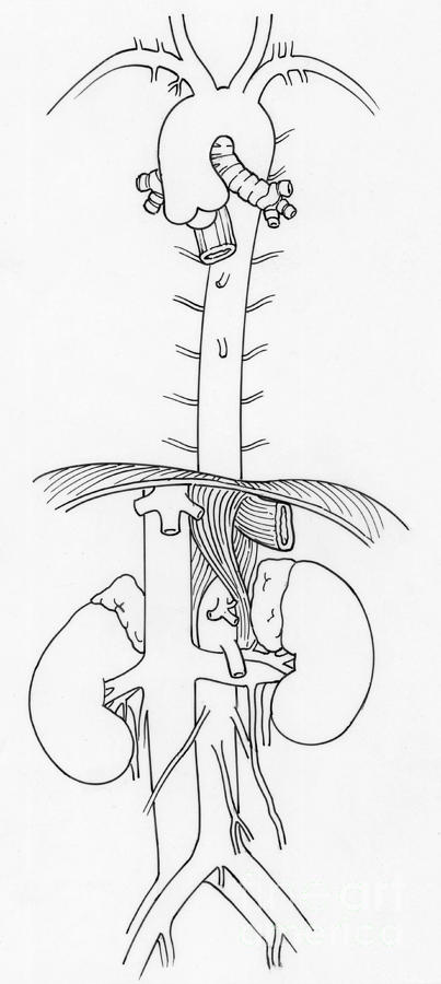 Illustration Of Aorta And Branches Photograph by Science Source