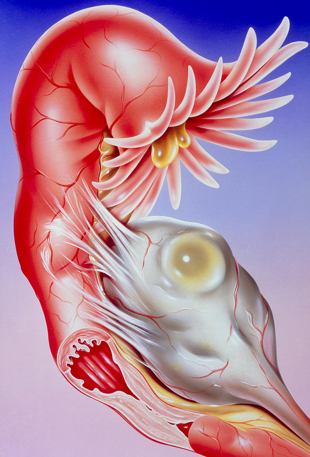 Infertility Photograph - Illustration Of Fallopian Tube Infertility by John Bavosi