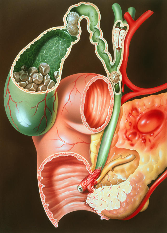 Gallstone Photograph - Illustration Of Invading Carcinoma Of The Pancreas by John Bavosi