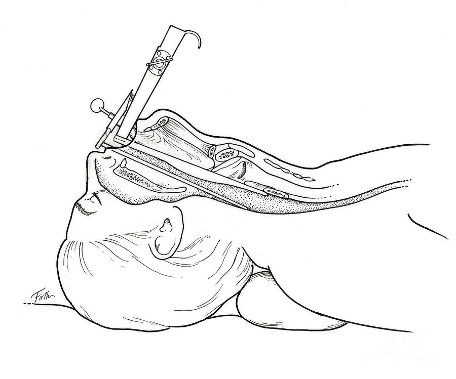 Illustration Of Laryngoscopy Photograph by Science Source - Fine Art ...