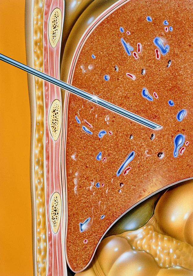 illustration-of-liver-biopsy-procedure-by-needle-photograph-by-john-bavosi