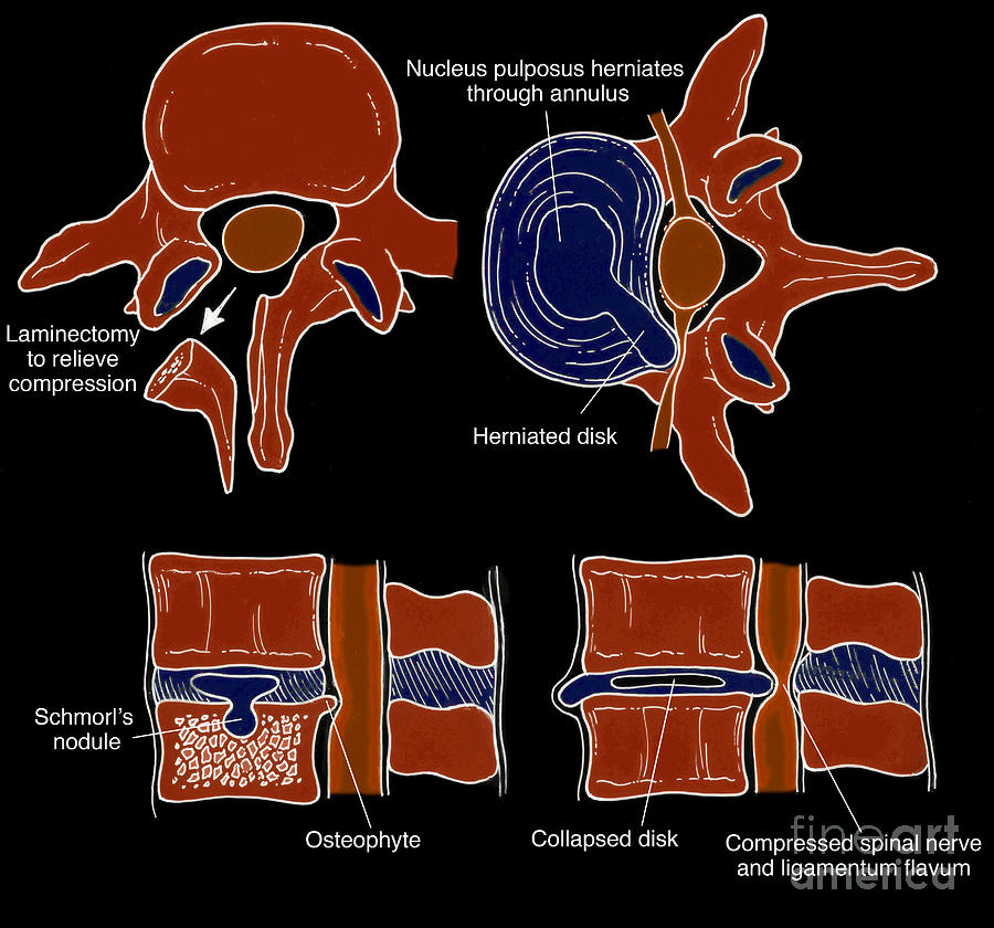 Illustration Of Spinal Disk Pathologies Photograph by Science Source