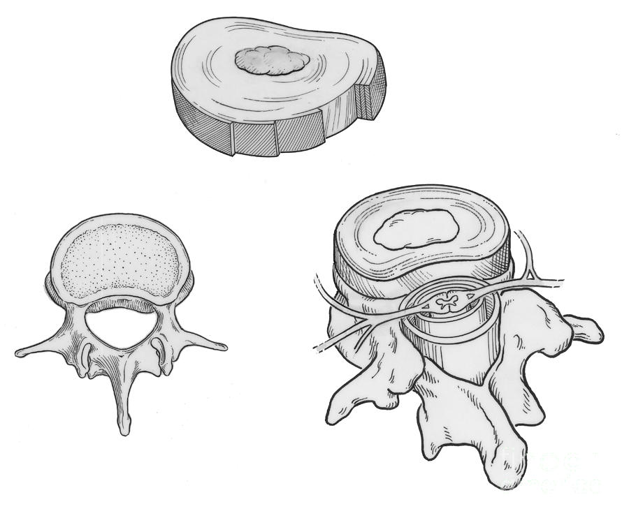 Illustration Of Spinal Disks Photograph by Science Source - Pixels