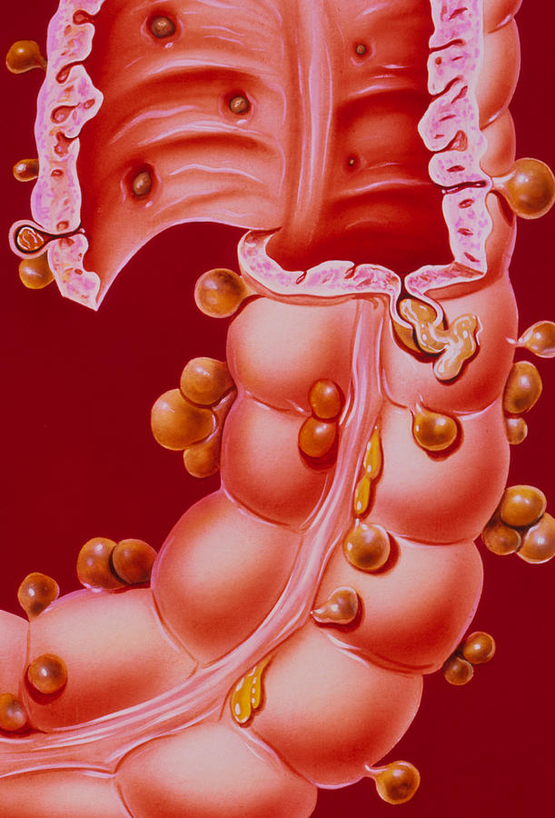 Illustration Showing Diverticulitis Of The Colon Photograph By John Bavosi 4621