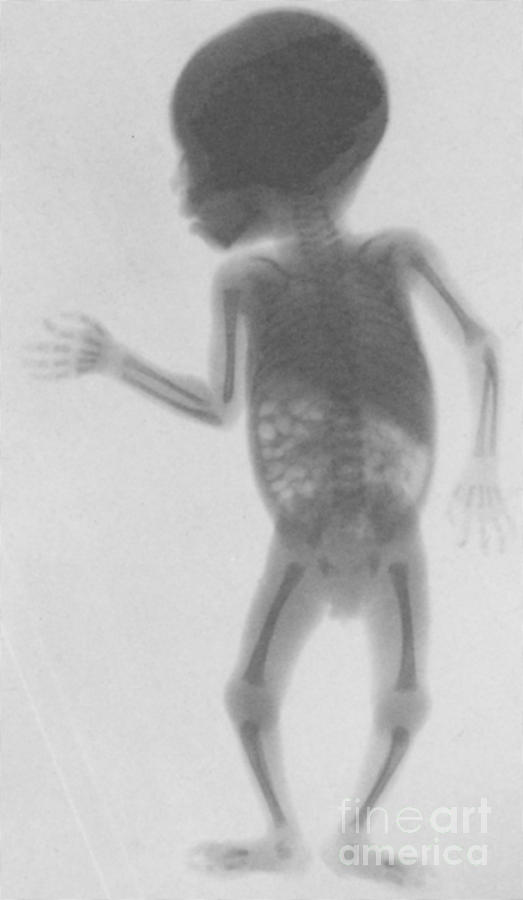 Infant X-ray, 1900 Photograph by Science Source