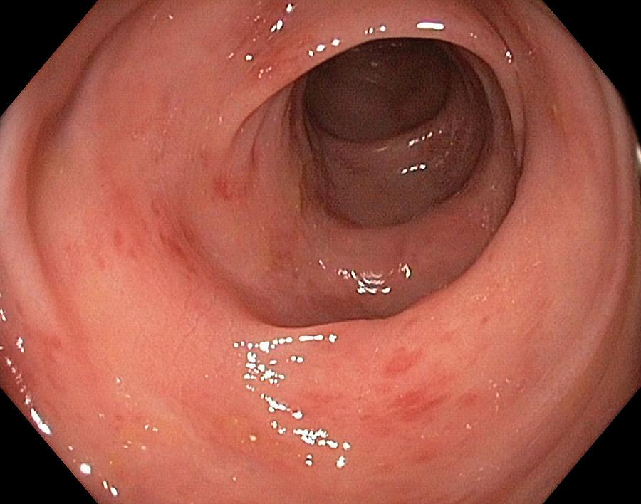 Endoscopy Photograph - Inflamed Colon From Viral Gastroenteritis by Gastrolab