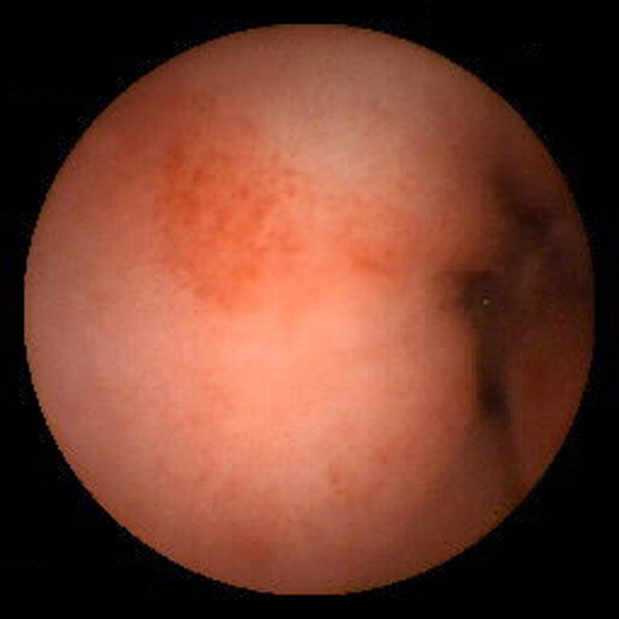 Duodenitis Photograph - Inflammation Of The Duodenum, Pill Camera by David M. Martin, Md
