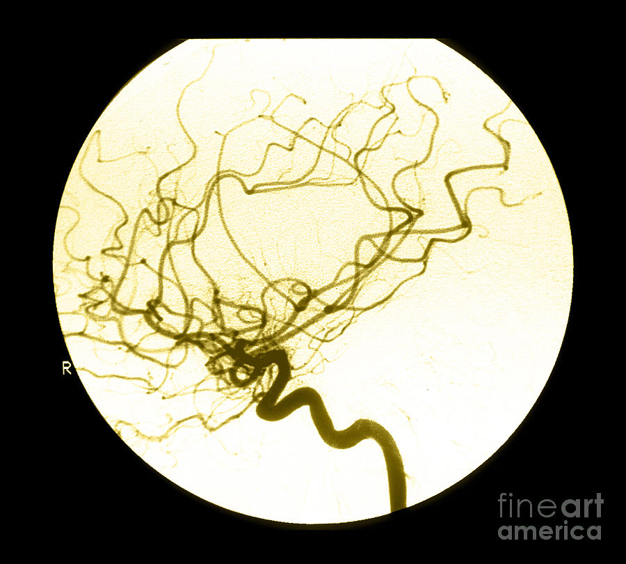 Internal Carotid Cerebral Angiogram Photograph by Medical Body Scans