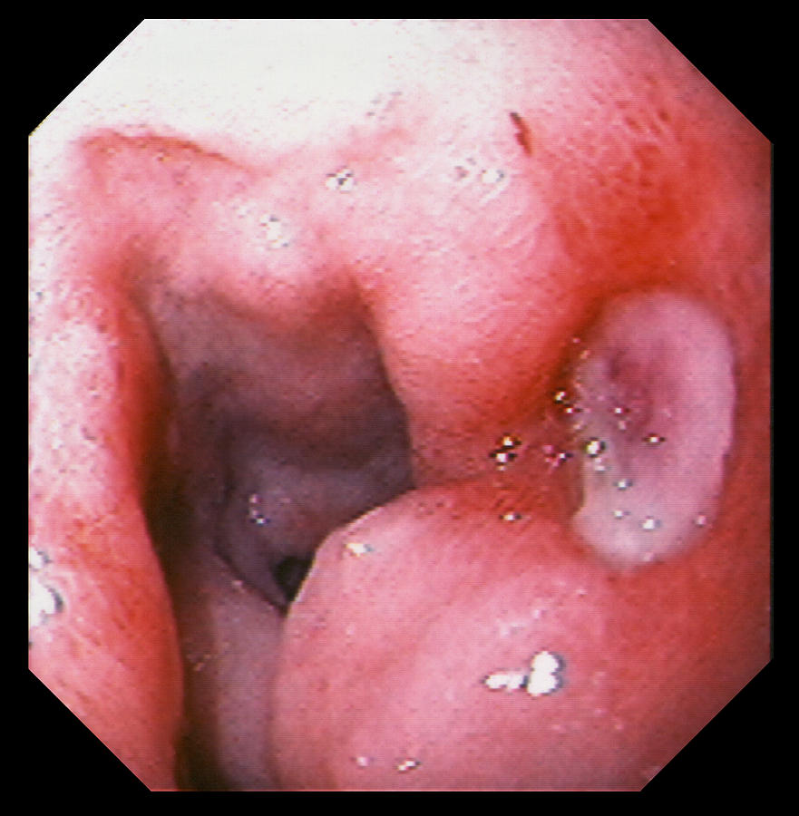 Ulcer Photograph - Intestinal Ulcer by David M. Martin, Md