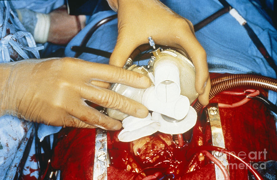 Jarvik Artificial Heart Photograph by Science Source