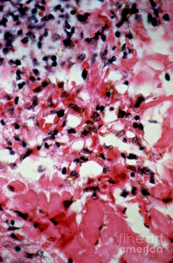 Kaposi Sarcoma, Lm Photograph by Science Source
