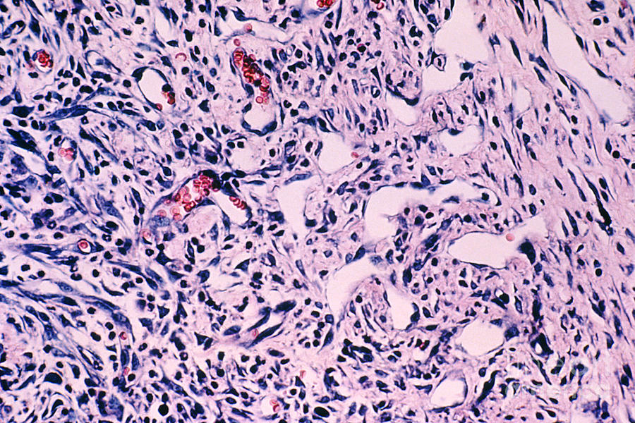 Kaposis Sarcoma Photograph by Science Source
