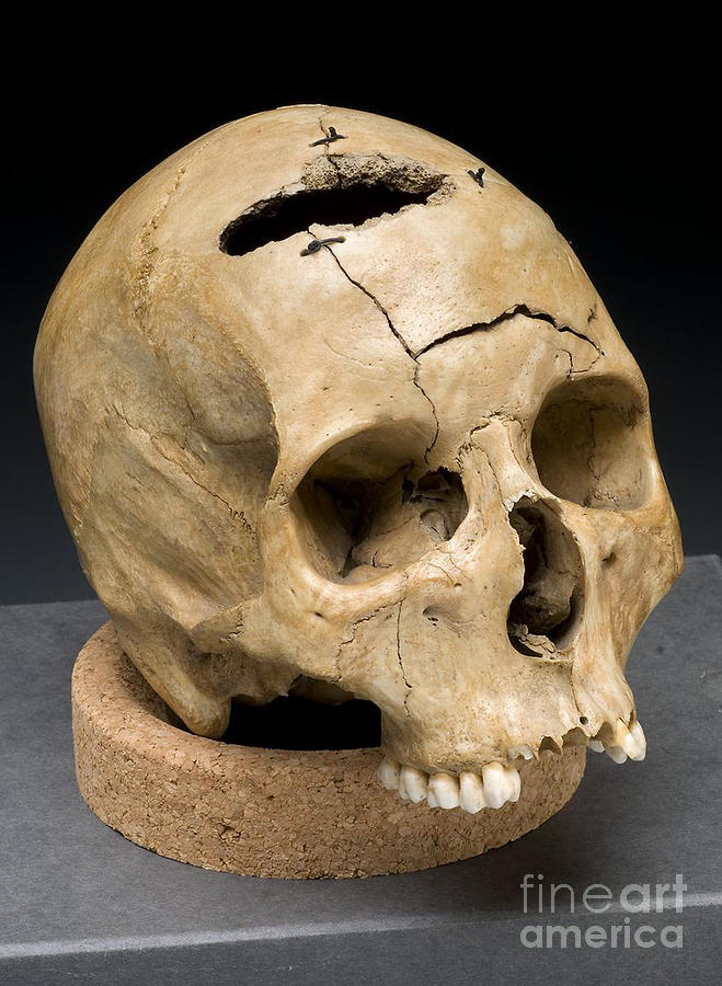 Skull Photograph - Keyhole Gunshot Trauma, 1860s by Science Source