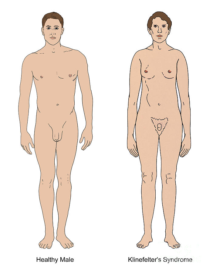 xxy chromosome female