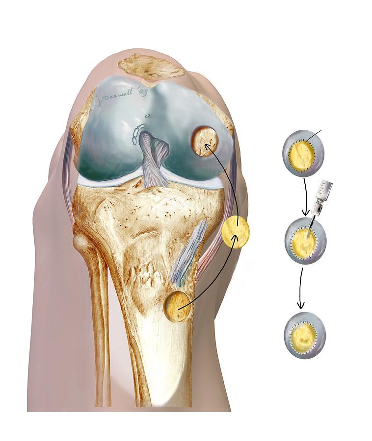 reconstitution-cartilage-genou-lemainal