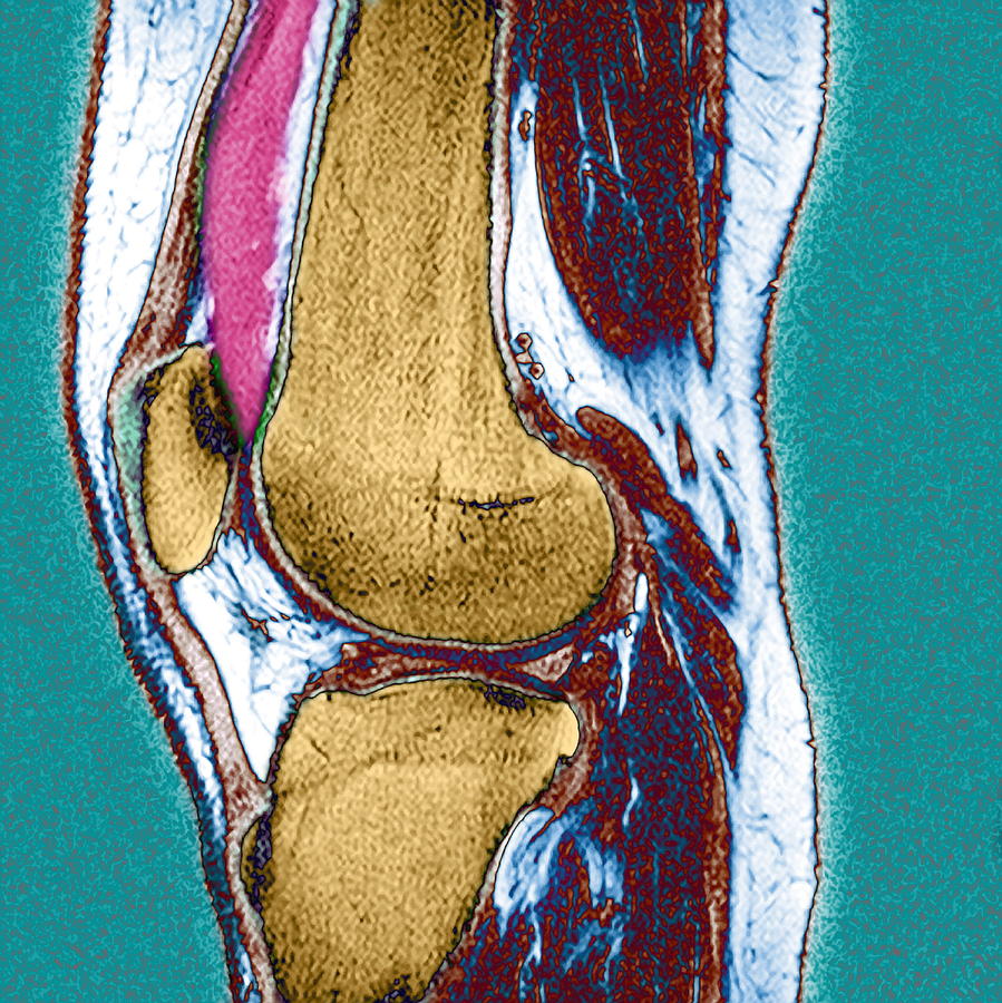 knee effusion