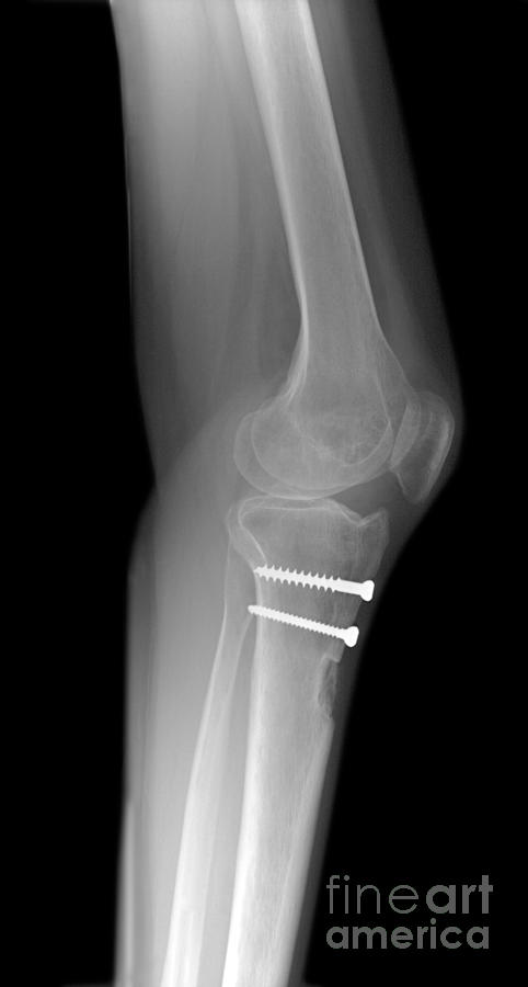 Knee Joint Photograph by Ted Kinsman