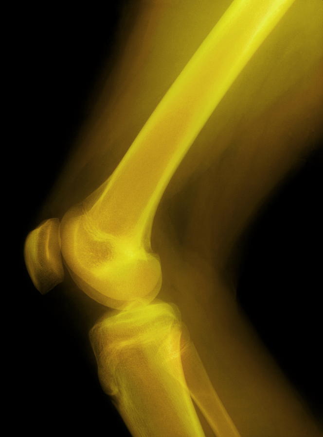 Knee Photograph - Knee Joint, X-ray by.