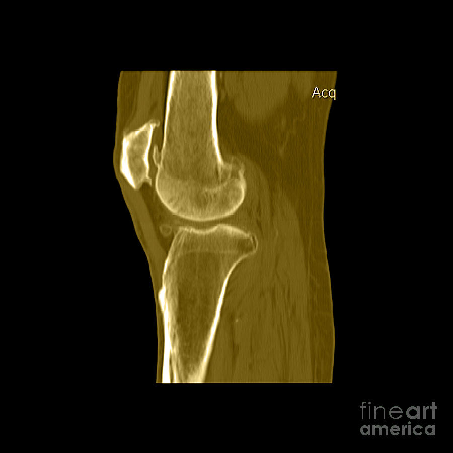 Knee Showing Osteoporosis Photograph by Medical Body Scans