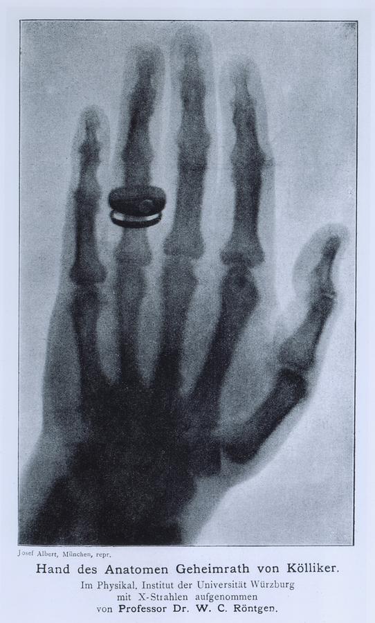 Skeleton Photograph - Konrad Roentgens X-ray Of The Hand by Everett
