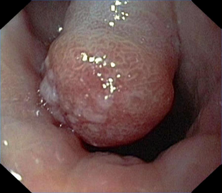Endoscopy Photograph - Large Polyp In The Stomach by Gastrolab
