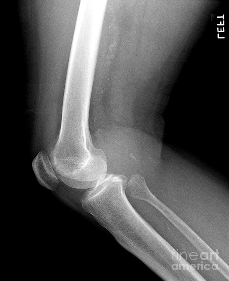Lateral X-ray Of The Knee Photograph by Medical Body Scans