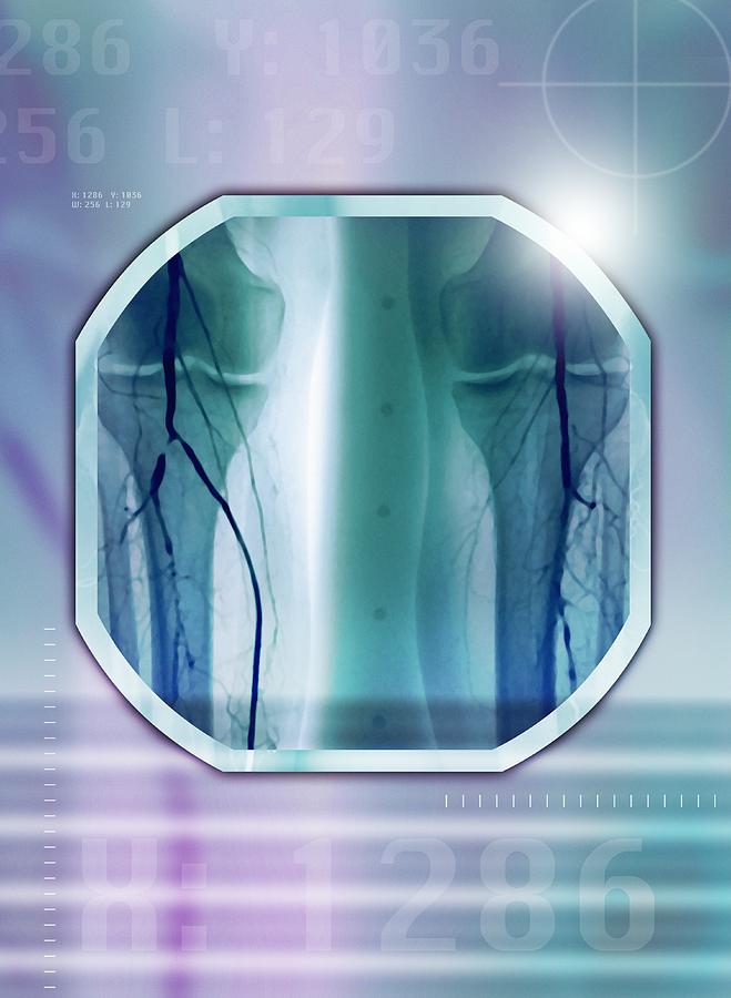Leg Artery Stenosis Angiogram X Ray Photograph By Miriam Maslo Fine