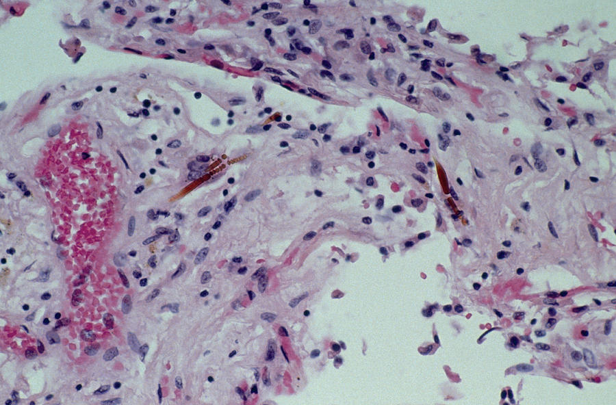 Light Micrograph Of Asbestos Fibres In Lung Tissue Photograph by Dr. E. Walker