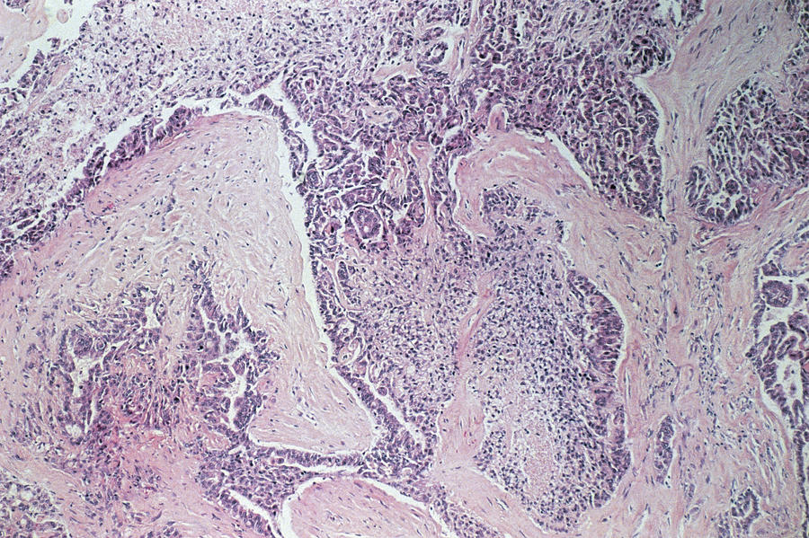 Light Micrograph Of Mesothelioma Lung Tumour Photograph by Dr. E. Walker