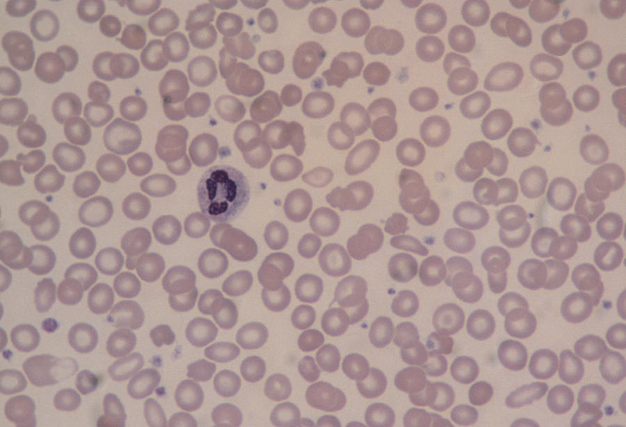 Lm Of Blood Smear Showing Iron-deficiency Anaemia Photograph by Dr. E ...