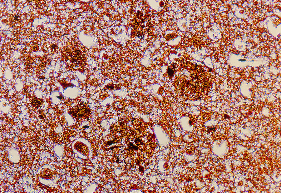 Lm Of Brain Tissue Affected By Alzheimer's Disease Photograph by ...