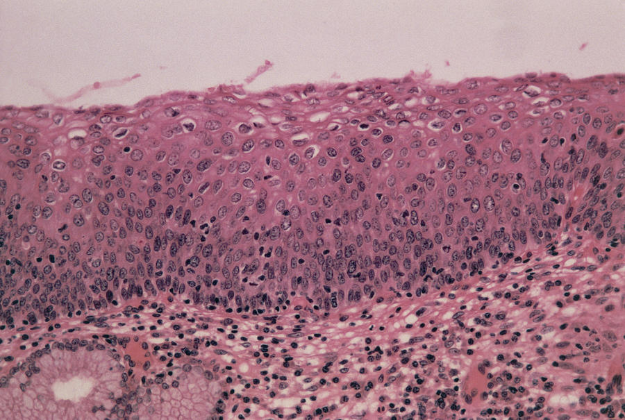 lm-of-cervical-cells-showing-mild-dysplasia-cin1-photograph-by-dr-e