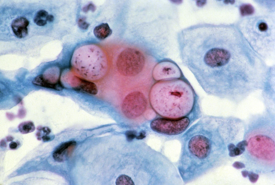 Images Photograph - Lm Of Cervical Smear Showing Chlamydia Infection by National Cancer Institute