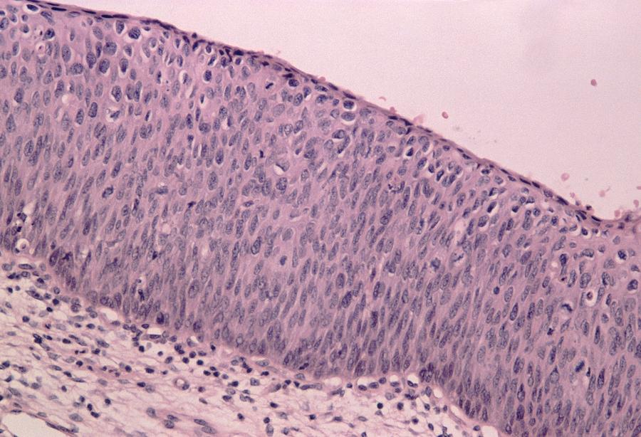 Lm Of Cervix Showing Severe Dysplasia Cin 3 Photograph By Dr E