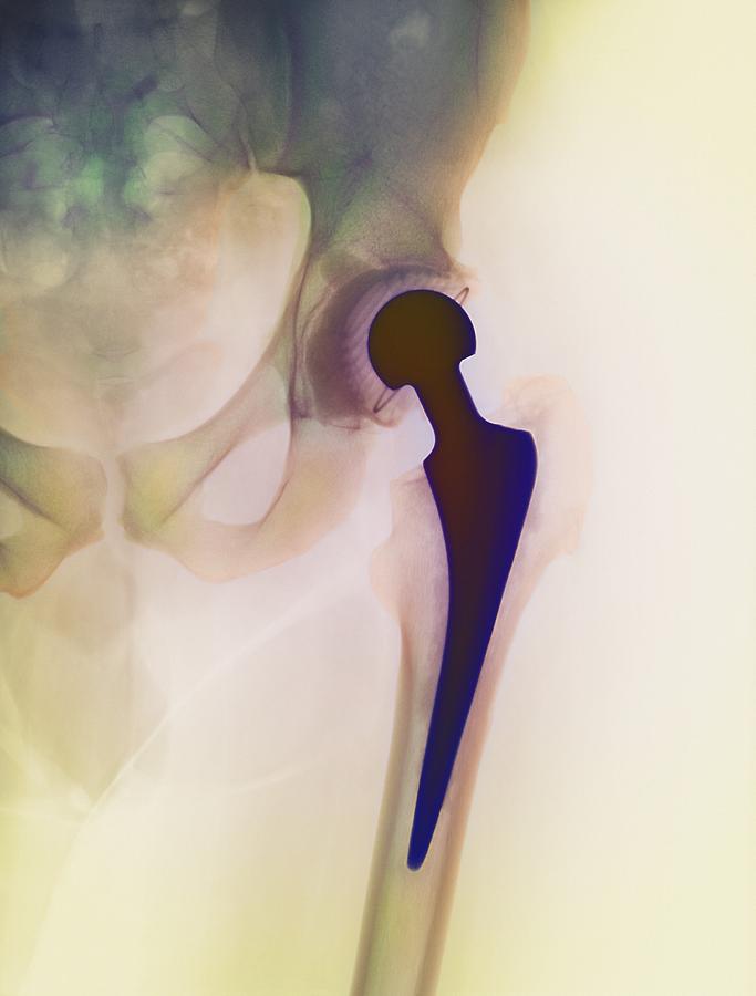 Hip Photograph - Loosened Hip Replacement, X-ray by 