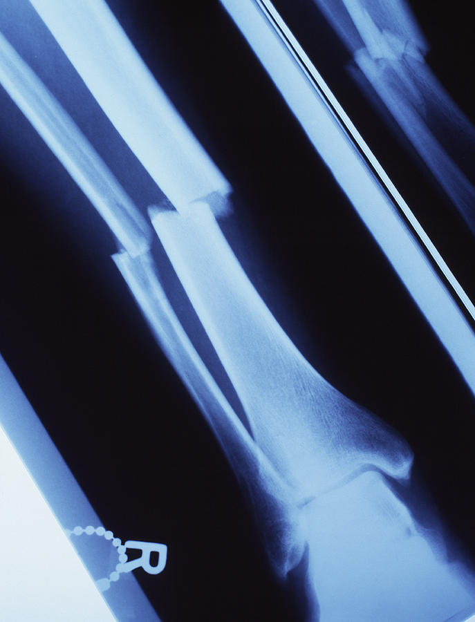 Lower Leg Fracture, X-ray Photograph by Tek Image - Fine Art America