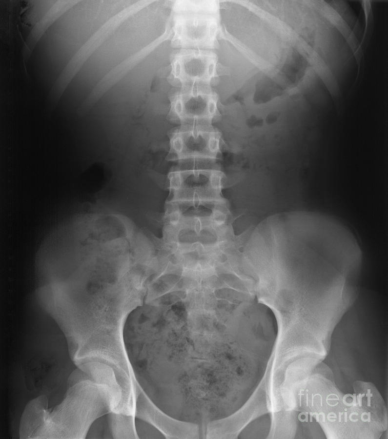 normal femail hip xray
