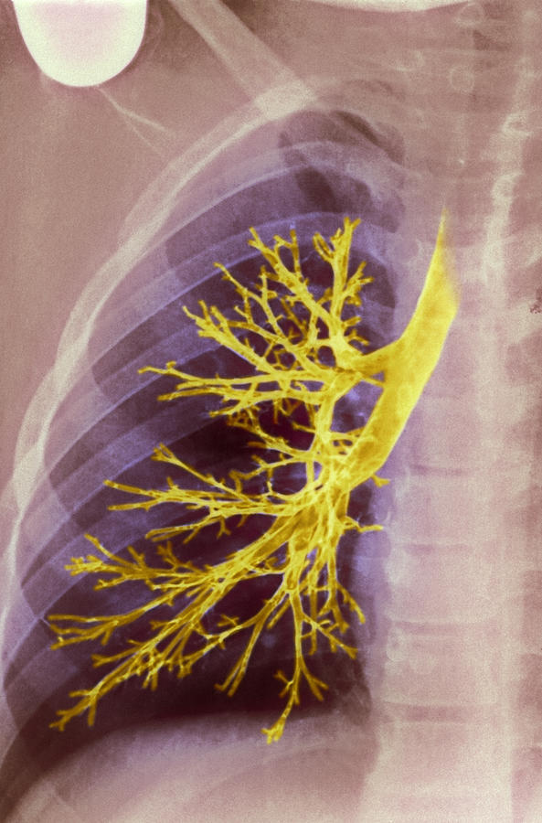 Lung Photograph - Lung Bronchioles, X-ray by Cnri