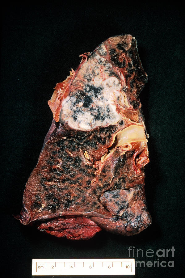 Cancer Photograph - Lung Cancer by Science Source