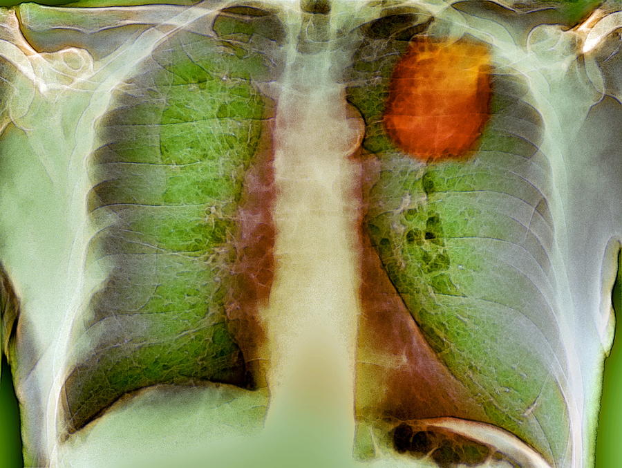 Lung Cancer, X-ray Photograph by Du Cane Medical Imaging Ltd | Fine Art ...