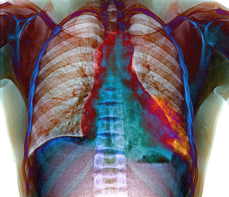 Disease Photograph - Lung Infection by Du Cane Medical Imaging Ltd