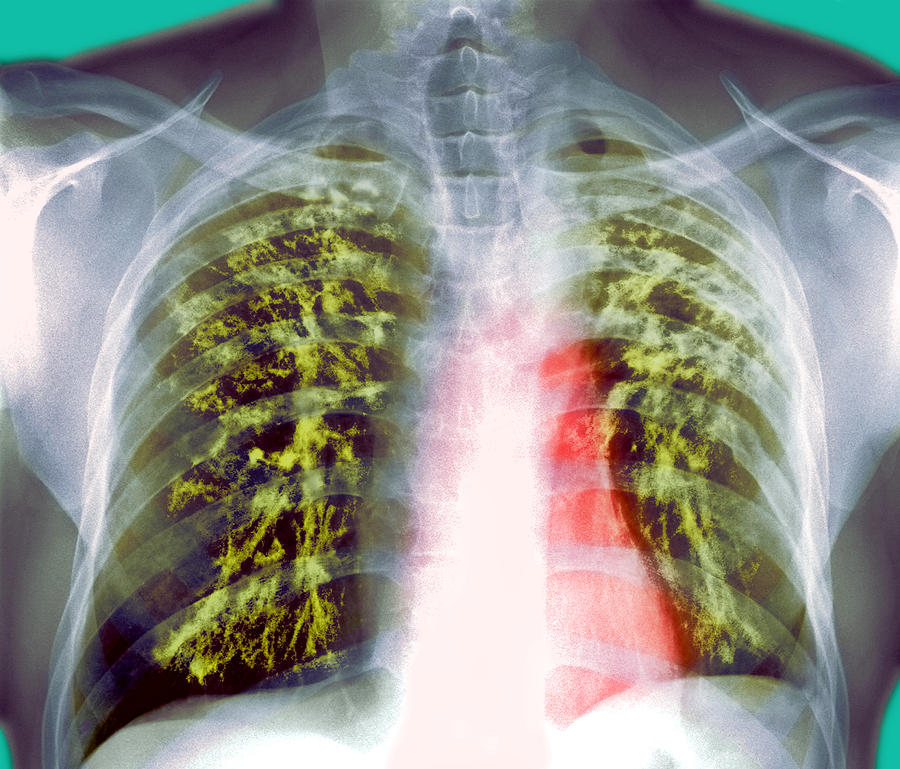 Lung Scarring From Tuberculosis, X-ray Photograph by Du Cane Medical